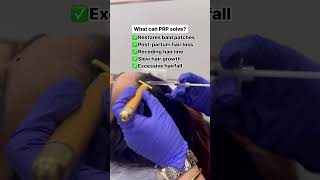 Hair growth with PRP  Welona Clinic Chennai [upl. by Saticilef]