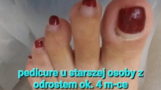 pedicure u seniora z odrostem ok 4mce podologia podopogotowie podology [upl. by Yelak653]