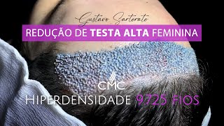 Redução de TESTA ALTA feminina [upl. by Roice]