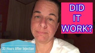 Epidural Steroid Injection Chronic Pain Series Vlog 3 [upl. by Caterina230]