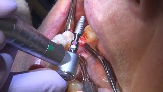 Chairside Live Episode 154 Posterior Implant Problems [upl. by Nutter915]