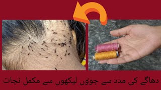 Sar Ki Juen Khatam Karne Ka Tarika  Head Lice Removal  Anti Lice Treatment At Home [upl. by Lucretia]