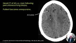 Air Embolism Risk Factors Detection and Intervention Presentation [upl. by Elohcin]