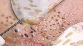 NEW Pimple Popping Compilation  Blackheads removal  Pimple removal vids of 2021 [upl. by Ahsyak]