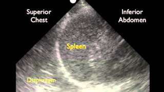 Anleitung FASTTraumauntersuchung – Untersuchung des linken Oberbauchs [upl. by Manoop]