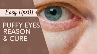 Banish Eye Bags Causes and Cures English [upl. by Esojnauj]