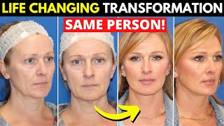 Incredible facelift transformation at 49 years old [upl. by Adriell524]