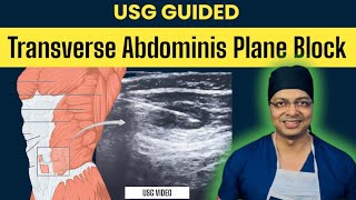 ULTRASOUND GUIDED TAP BLOCKSONOANATOMY and PROCEDURE with real USG VIDEO [upl. by Winwaloe281]