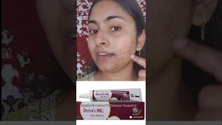 🌼Acne Acne treatment Pimples Acne cream Deriva CMS Gel shorts [upl. by Ingra]