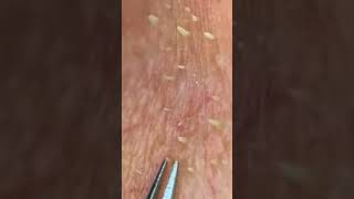 Sebum removal whiteheads komedo beauty blackheads [upl. by Peyton]