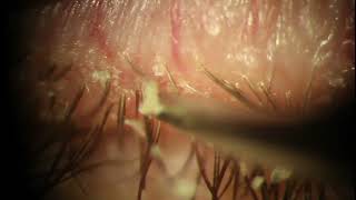 Demodex Blepharitis Plaque Removal with Forceps  Eyelash Mite at 539 [upl. by Ahsekram414]