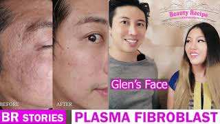 What is Plasma Fibroblast Skin Tightening Treatment in detail [upl. by Salem293]