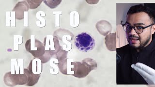 Como é feito o diagnóstico de Histoplasmose É possível diagnosticar histoplasmose no sangue [upl. by Auqenet]