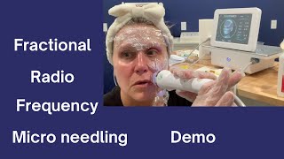 Fractional Radio Frequency Micro Needling For Home Use Demo [upl. by Eirrab]