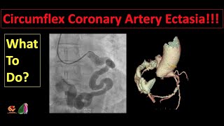 Circumflex Coronary Artery Ectasia What To Do [upl. by Gaelan]