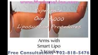 Arms Liposuction Before and After MyShape Lipo [upl. by Hairehcaz]