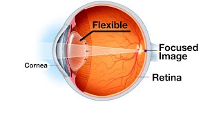 Mayo Clinic Minute Blurry vision as you age [upl. by Phelps350]