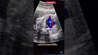 Embarazadas Ecocardiograma doppler fetal con cardiopatías grave [upl. by Yelsgnik]