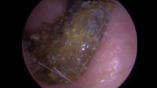 274  Ear Wax Removal with St Barts Ear Wax Hook  Mr Neel Raithatha The Hear Clinic [upl. by Nirrak]