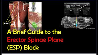 ESP Block  How To Perform It Effectively amp Safely 2022 [upl. by Nyrmac]