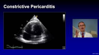 Treatment of Complicated Pericarditis [upl. by Ardnassac]