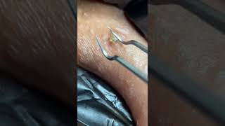 ingrown hair removal 😌 ENJOY [upl. by Atiuqam]