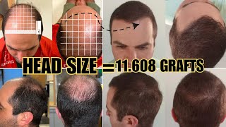 Dr Pittella Head Size Changes The Number of Grafts Heres Why [upl. by Brelje]