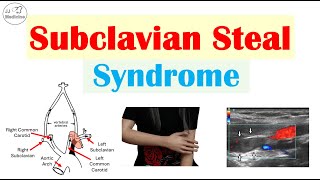 Subclavian Steal Syndrome “Stealing Blood From Brain” Risk Factors Symptoms Diagnosis Treatment [upl. by Nashom]