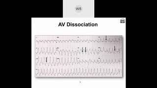 Wide Complex Tachyarrhythmias Part 2 Morphological Differences amp Identifying Factors [upl. by Suivatnad]