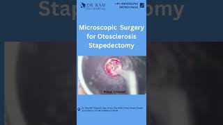 👂🔍 Dive into the World of Microscopic Surgery for Otosclerosis Stapedectomy at Dr Ram ENT Hospital [upl. by Ahseena]