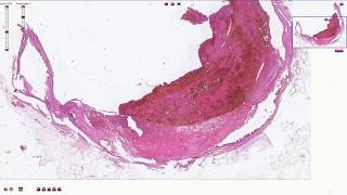 Atheromatous Plaque with Thrombosis  Histopathology [upl. by Ibed]