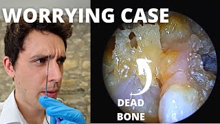 Dead Bone And Infection In Ear Cavity Mastoid Sequestrum And Granulation [upl. by Ertnom547]