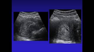 SonoWorld Retained Products of Conception [upl. by Bates]