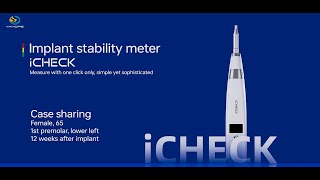 Case sharingiCheck IST equals to ISQ [upl. by Arakihc]