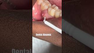 DENTAL ABSCESS abscess dental viraltrending video shorts youtubeshorts fashion fyp po [upl. by Azeria]