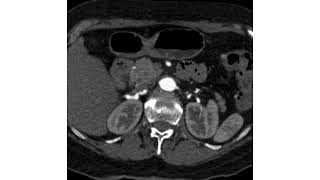 Fibromuscular Dysplasia [upl. by Semadar]