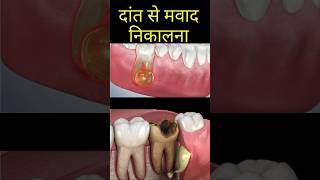 Dental abscess  Pus discharge from gum  Dr Lahna Singh teeth toothdecay [upl. by Harlin]