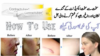 contractubex  contractubex gel  contractubex gel how to use  contractubex gel for acne scars [upl. by Notrab118]