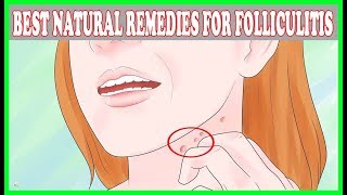 Folliculitis Treatment  9 Effective Natural Remedies For Folliculitis  Best Home Remedies [upl. by Fridell]