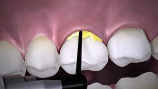 Periodontitis Management [upl. by O'Meara]