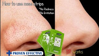 How to SAFELY get rid of blackheads amp whiteheads💯 Proven Effective [upl. by Ytima]