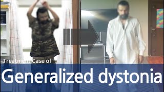 Generalized Dystonia  Cervical dystonia Dysphonia Oromandibular dystonia  전신 디스토니아 치료사례  근긴장이상증 [upl. by Stout]