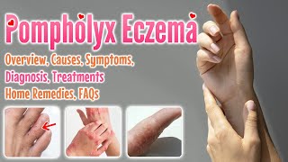 Pompholyx eczema causes symptoms diagnosis treatment home remedies FAQ  Dyshidrotic eczema [upl. by Aydan]