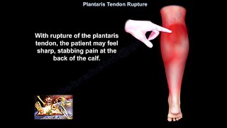 Plantaris Tendon Rupture  Everything You Need To Know  Dr Nabil Ebraheim [upl. by Fessuoy]