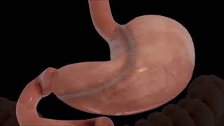 Laparoscopic sleeve gastrectomy procedure animation [upl. by Araeic]