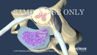 Cervical Disc Herniation [upl. by Dronel411]