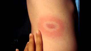 Erythema Chronicum Migrans from Ixodes Tick Bite Lyme Disease Borrelia [upl. by Jar]