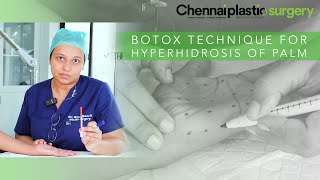 BOTOX TECHNIQUE FOR HYPERHIDROSIS OF PALM [upl. by Knobloch]