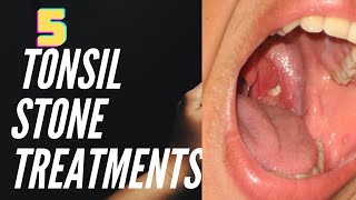 5 Tonsil Stone Treatments [upl. by Remoh767]