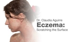 Eczema Scratching the Surface [upl. by Aidam]